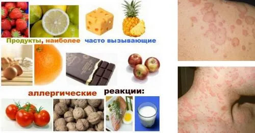 як лікувати штучну кропив'янку