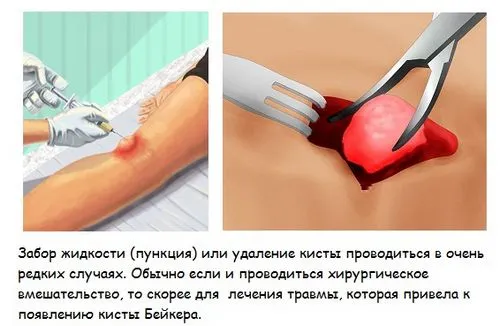 як лікувати кісту Беккера під коліном