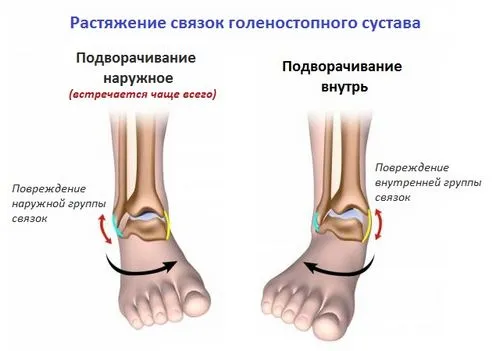 як лікувати розтягнення м'язів