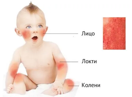 як лікувати діатез у немовляти