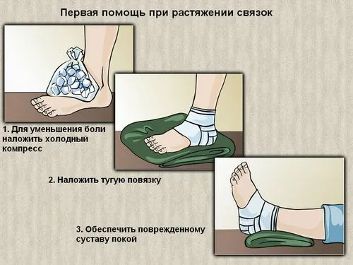 як лікувати розтягнення м'язів