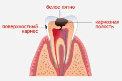 лікувати чи карієс молочних зубів