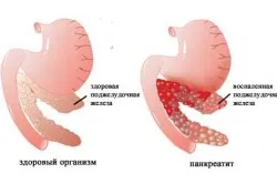 лікування запору