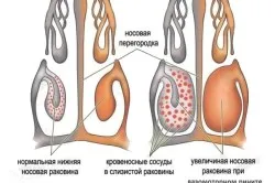 як лікувати нежить рідкий