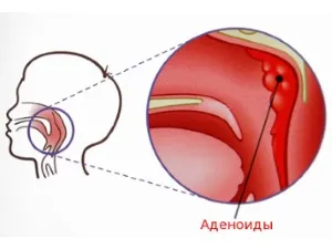 чи можна вилікувати аденоїди Назонексом