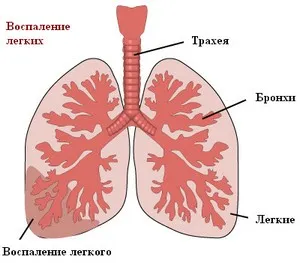 як лікувати пневмонію і бронхіт