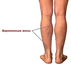 як лікувати варикоз ніг у чоловіків