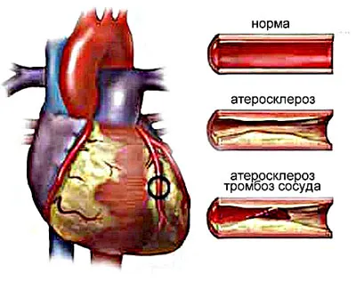 як лікувати синусовую тахікардію народними засобами
