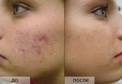 як лікувати прищі щоб не залишалося слідів