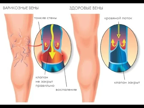 як лікувати варикоз простими способами працює на 100