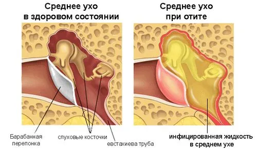 як лікувати отит при грудному вигодовуванні