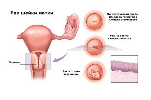у кого лікувати папіломи