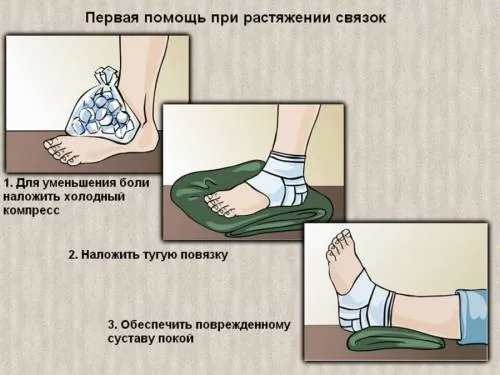 як лікувати розтягнення