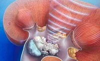 як лікувати хронічний холецистит