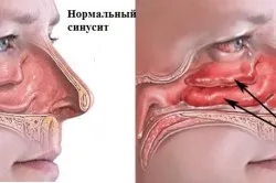 лікування риніту