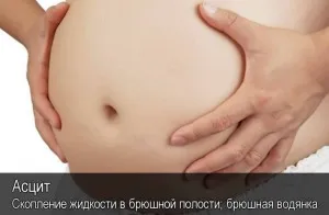 Як вилікувати асцит при цирозі печінки? як лікувати асцит печінки