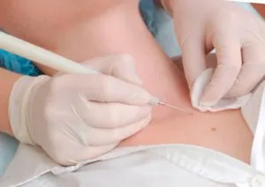 як лікувати папіломи ефективно дому та без лікарів
