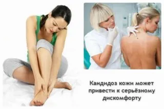 як лікувати кандидоз шкіри