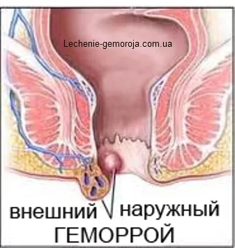 вилікувати геморой раз і назавжди