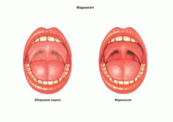 як швидко вилікувати фарингіт народними засобами