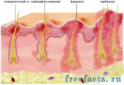 Як вилікувати фурункул без операції як вилікувати фурункул без операції
