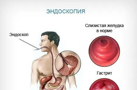 як вилікувати шлунок гастрит
