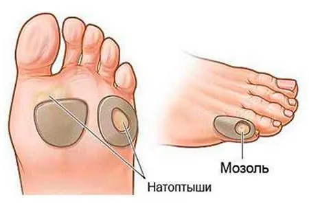 як вилікувати вологу мозоль