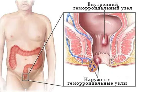 Як вилікувати геморой вилікувати геморой за тиждень