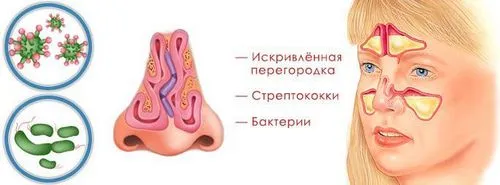як лікувати легкий гайморит