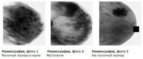 карцинома молочної залози