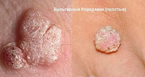 вилікувати бородавки