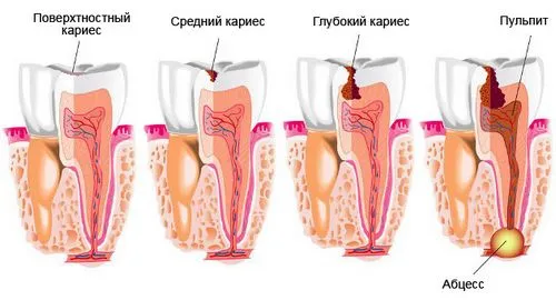 лікування карієсу зубів