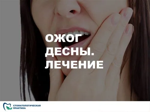 Як вилікувати опік ясна лікувати опік ясна хімічний термічний недорого якісно відгуки про стоматологів зубних лікарів дантиста декотрих болить ясна лікування опіків фото без болю стоматологічна практика клініка челябінськ стомпрактіка вартість ціни скільки коштує