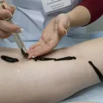 як лікувати суглоби брудом