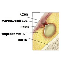 як лікувати кісту куприка в домашніх умовах