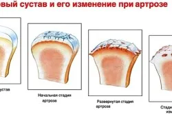 як лікувати артроз кистей рук