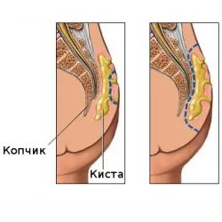 як лікувати кісту куприка