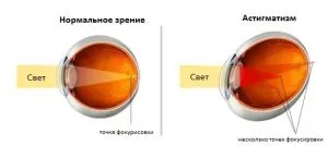 вилікувати короткозорість будинку