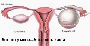 Кіста яєчника як лікувати кісту яєчника травами