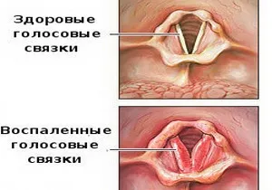 ознаки ларингіту у дітей