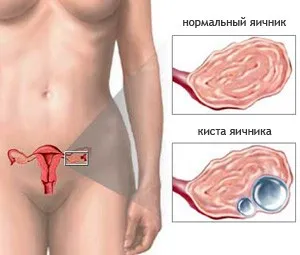 кіста яєчника доброякісна новоутворення пухлина причини симптоми діагностика лікування профілактика лапароскопія