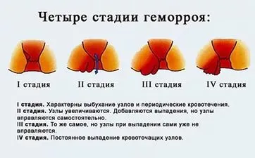 як лікувати легкий геморой