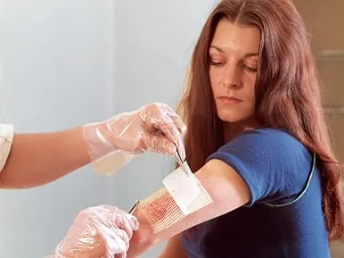 як лікувати фурункул після розтину
