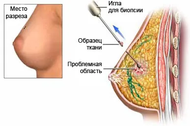як вилікувати кісту без гормонів