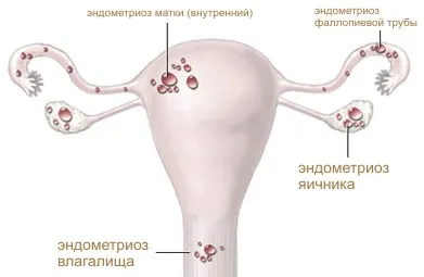 лікування матки