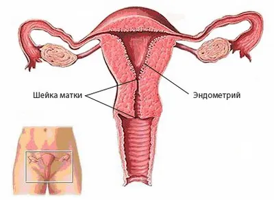 лікування ендометріозу