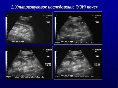 як лікувати кісту лівої нирки