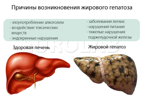 як лікувати гепатоз печінки