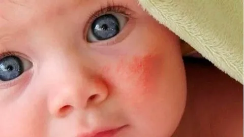 як лікувати дерматит у дитини народними засобами