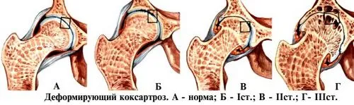 як вилікувати коксартроз
